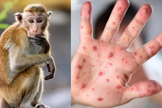 WHO nhận định đậu mùa khỉ chưa phải là tình trạng khẩn cấp y tế toàn cầu