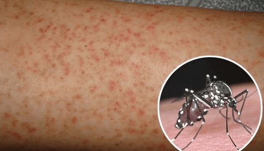 Chủng sốt xuất huyết DEN-2 có thể làm gia tăng ca bệnh nặng
