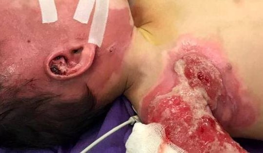 Tự chữa bỏng bằng lá cây, thuốc nam không nguồn gốc gây biến chứng nặng