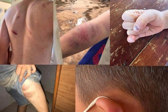 Khởi tố cha ruột và bà nội trong vụ bé trai 9 tuổi bị bạo hành ở Đắk Lắk