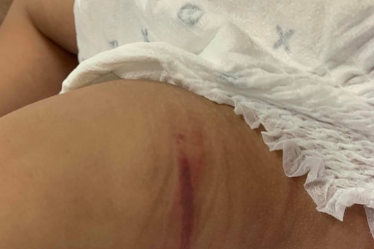 Tình hình sức khỏe của cháu bé 18 tháng tuổi bị bạo hành 
