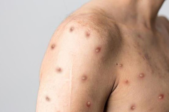 WHO kêu gọi ngăn đậu mùa khỉ trở thành đại dịch thứ hai sau COVID-19
