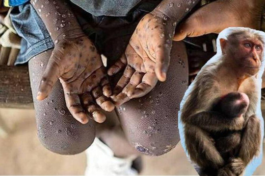 Tin vắn thế giới ngày 1/8: Ấn Độ ghi nhận trường hợp đầu tiên tử vong vì bệnh đậu mùa khỉ