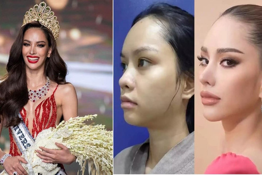 Tân Hoa hậu Hoàn vũ Thái Lan lộ ảnh phẫu thuật thẩm mỹ