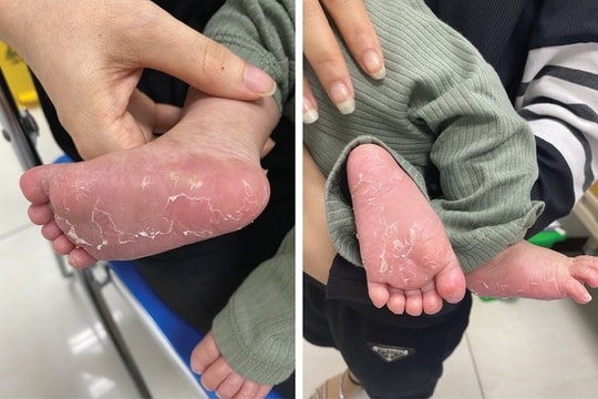 Bé trai chào đời mắc bệnh giang mai bẩm sinh