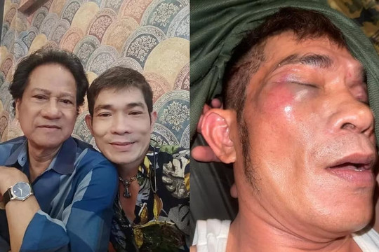 Con trai của danh ca Chế Linh bất ngờ bị đánh hội đồng, hàng loạt vết thương gây lo lắng