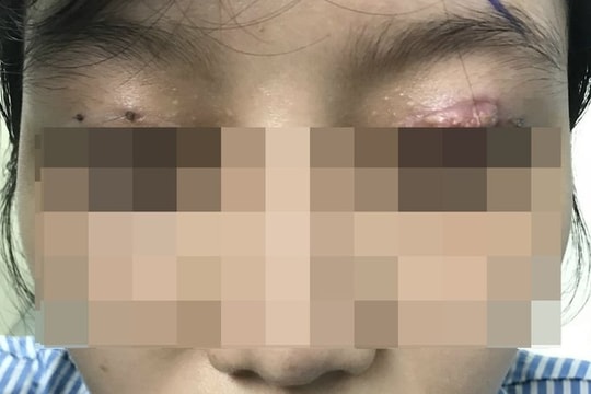 Thủng lỗ trong mắt, vỡ thủy tinh thể sau gây tê cắt mí