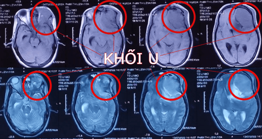 9 giờ "cân não" cứu thai phụ u não hôn mê, nguy kịch