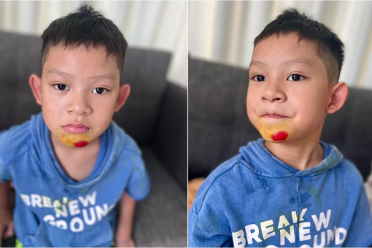 Cậu út nhà Lý Hải thêm bề dày tai nạn vì nghịch ngợm: Hết ngã gãy tay, gãy xương đòn, mới nhất là ngã téc cằm, mặt mày bầm dập