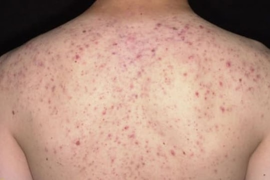 Suýt tử vong sau 30 phút lăn kim trị mụn ở spa