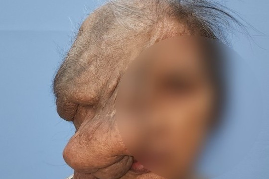 Cụ bà mang khối u che lấp nửa khuôn mặt