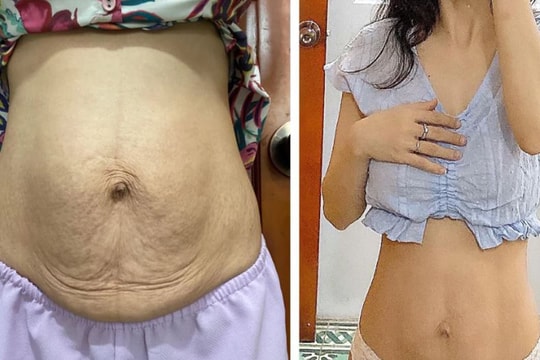 5 cách giúp bụng sau sinh xẹp nhanh hơn, xóa tan nỗi lo bụng chảy xệ, không săn chắc