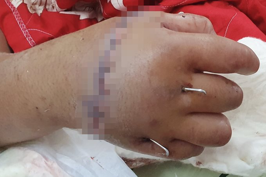 Nối bàn tay đứt lìa cho cậu bé 12 tuổi