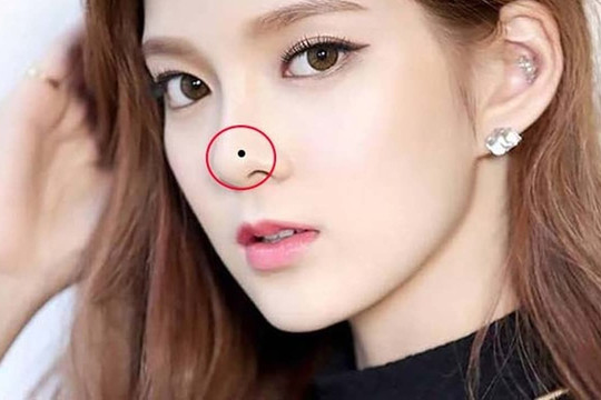 Trên mặt bỗng nhiên xuất hiện những nốt ruồi này, cẩn thận kẻo xui xẻo