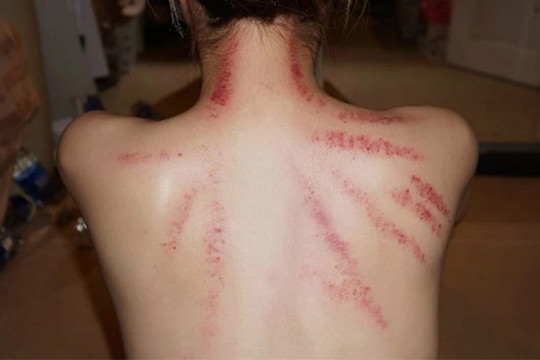 Bạn gái cởi áo để anh kết nghĩa cạo gió, bạn trai lên mạng thắc mắc: 'Mình giận dỗi là đúng hay sai'?