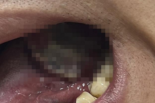 Đi khám nhiệt miệng phát hiện bị ung thư lưỡi giai đoạn 4