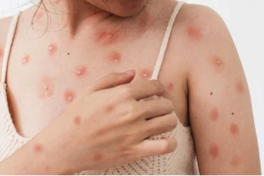 TPHCM phát hiện ca mắc đậu mùa khỉ mới