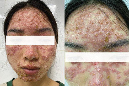 Đắp mặt nạ "detox" ở spa, cô gái nhập viện với gương mặt chi chít mụn nước