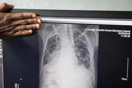 Tin vắn thế giới ngày 31/10: WHO cảnh báo ca mắc lao gia tăng toàn cầu sau gần 20 năm