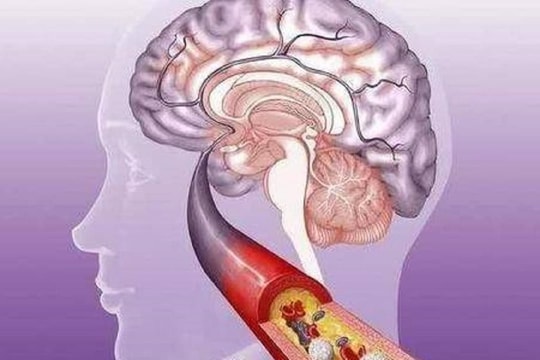 Khi 'nhồi máu não' đến, cơ thể sẽ phát ra 3 tín hiệu 'kêu cứu' này, bạn đừng phớt lờ