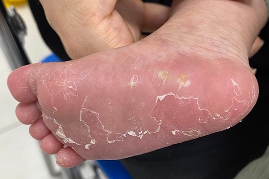 Bé 18 tháng tuổi bất ngờ được phát hiện mắc giang mai