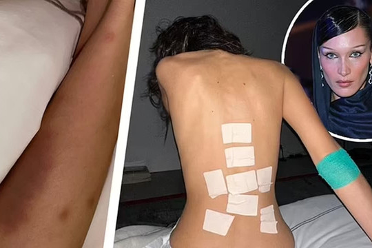 'Cô gái có khuôn mặt đẹp nhất thế giới' Bella Hadid gây lo lắng khi chia sẻ ảnh chân bầm tím và lưng dán đầy băng