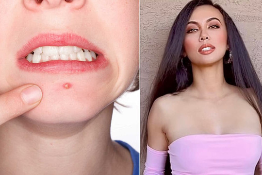 MC Huyền Ny bật mí 5 mẹo, chị em nên nhớ khi bị nổi mụn để nhanh chóng 'xẹp'