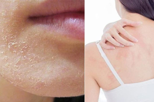 Nên và không nên làm gì khi da khô, bong tróc vào mùa lạnh?