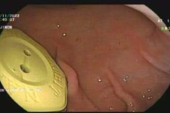 Cụ bà 70 tuổi nhập viện sau khi nuốt viên đá "chữa bách bệnh"