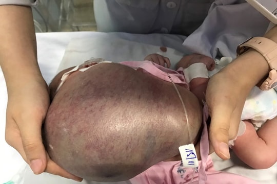 Bé sơ sinh "gánh" khối bướu hạch bạch huyết khủng 1,1kg