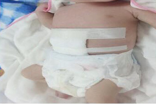 Em bé chào đời với ruột nằm ngoài ổ bụng