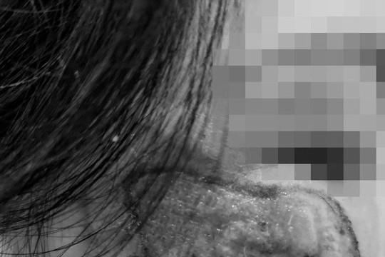 Mặt mưng mủ, nhiễm trùng do mua "thuốc chứa axit" trị nám