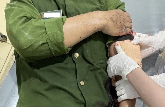 Chém Phó trưởng Công an phường bị thương