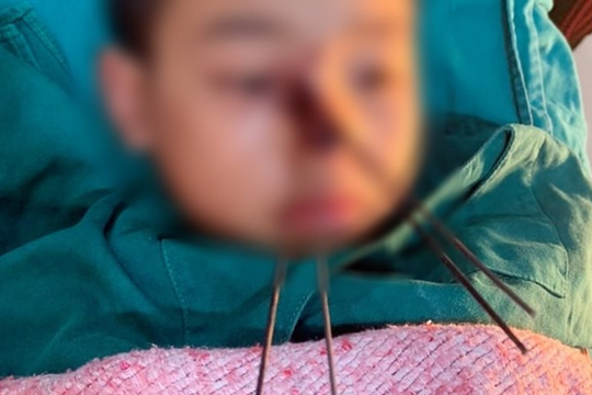 Nỏ tự chế "cướp cò" khiến bé trai bị nhiều mũi tên găm vào mặt