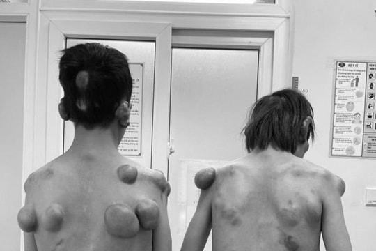 Cặp song sinh mắc bệnh hiếm gặp với hàng trăm khối u trên cơ thể