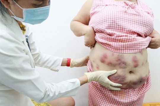 Người phụ nữ gặp họa vì tiêm tan mỡ theo quảng cáo trên mạng