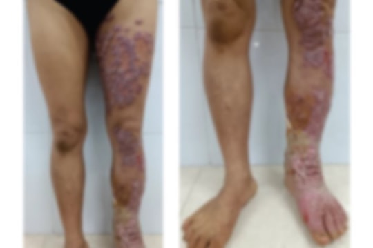 Chân lở loét, biến dạng vì nhiễm "loại nấm bị lãng quên"