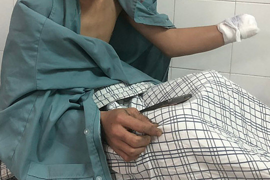 Phải cắt cụt bàn tay vì chơi pháo cận Tết