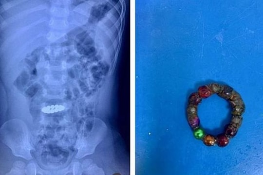 Bé 3 tuổi phải cắt ruột vì nuốt 14 viên nam châm