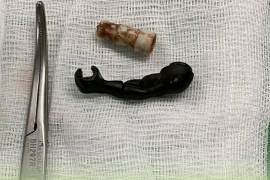 Nhiều dị vật trong vùng kín bé gái 5 tuổi