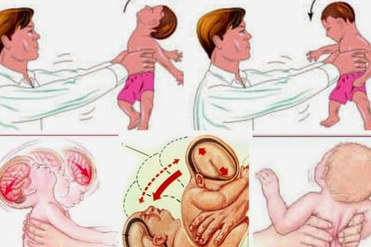 Bé 4 tháng tuổi xuất huyết não nghi do bị bế xốc, rung lắc mạnh