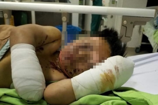 Vật lạ nghi pháo tự chế phát nổ, bé 8 tuổi cụt hai bàn tay