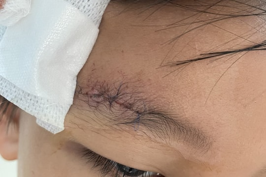 Nghịch súng hơi, bé trai bị đạn chì găm vào xương sọ
