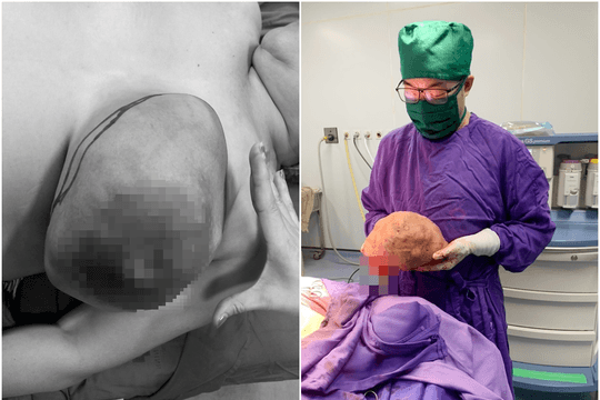 Người phụ nữ có ngực trái to gấp 10 lần bình thường