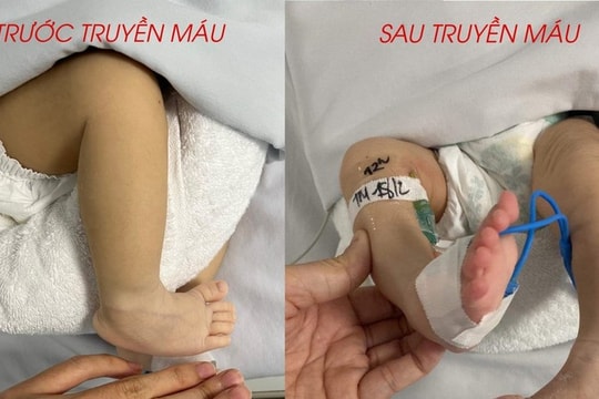 Bé sơ sinh có kháng thể trong máu chống lại các kháng nguyên phổ biến