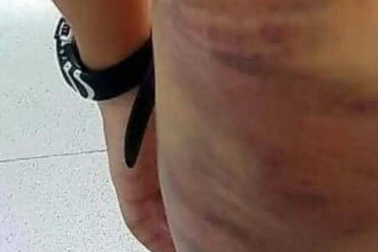 Khởi tố vụ án bé trai bị mẹ kế đánh với hơn 20 vết bầm trên cơ thể