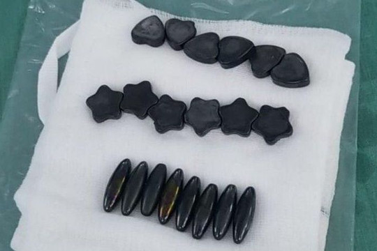 Nuốt 20 viên nam châm vì tưởng kẹo, bé trai phải cắt bỏ 15cm ruột