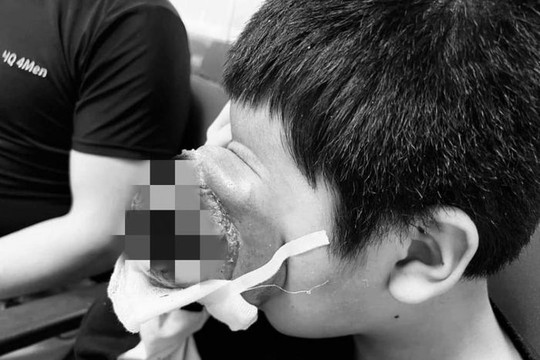 Bé trai 4 tuổi bị u "quái" khủng đẩy mắt lồi ra phía trước