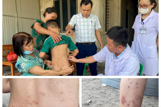 Hơn 100 người ở Hà Tĩnh bị viêm da dị ứng do côn trùng đốt