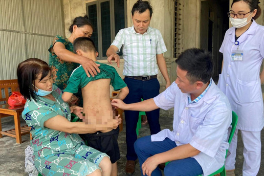 Côn trùng khiến 126 người ở Hà Tĩnh bị viêm da dị ứng là bọ chét